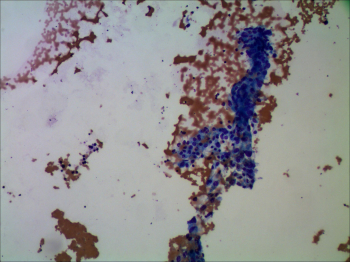 Cyst lining cells