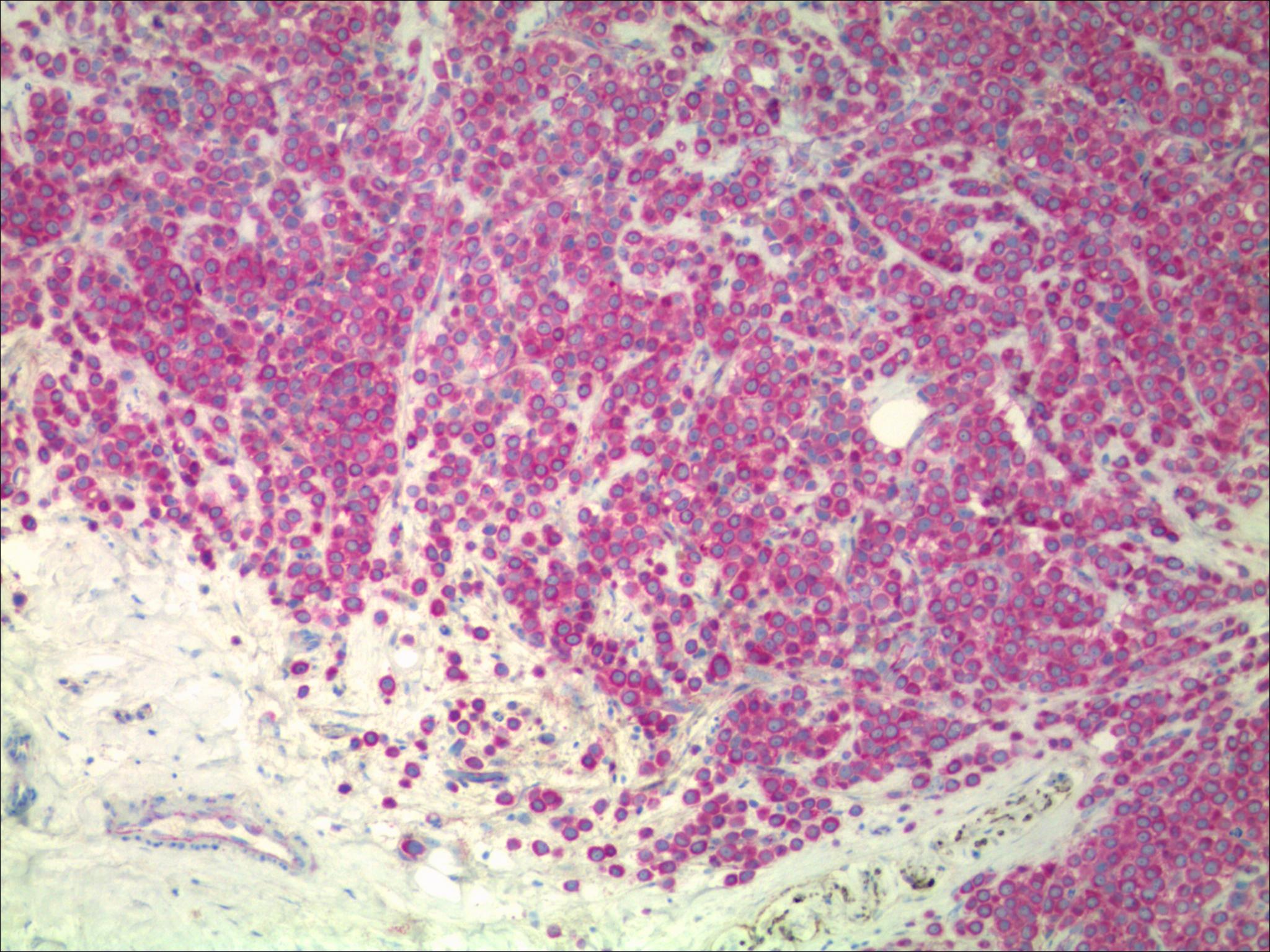 ecadherin p120 + invasive lobular ca