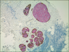 lobular carcinoma in situ